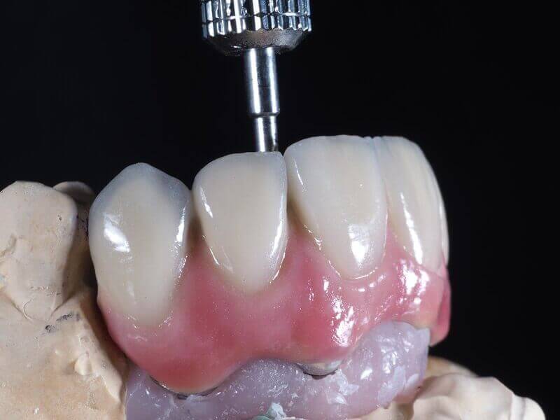 Trabajos complicados realizados en Exclusive Lab. Servicio exclusivo en prótesis dentales de alta calidad Trabajos complicados realizados en Exclusive Lab. Servicio exclusivo en prótesis dentales de alta calidad