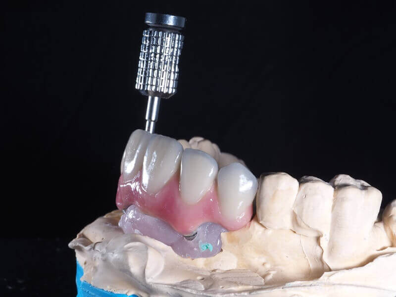Trabajos complicados realizados en Exclusive Lab. Servicio exclusivo en prótesis dentales de alta calidad