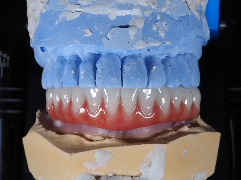 Cerámica hibrida de peek atornilladas con resina